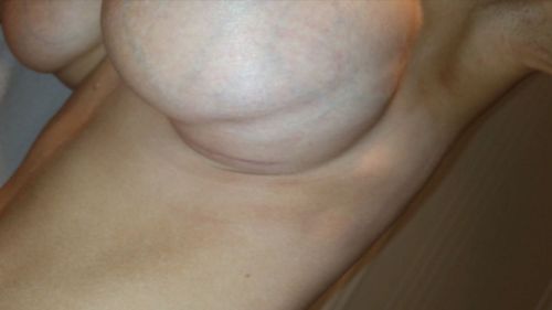 More breast surgery horror stories have emerged.