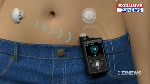 Funding for the implant comes after the Medtronic MiniMed 670G system, which continuously monitors blood glucose levels and automatically adjusts insulin delivery, was funded.