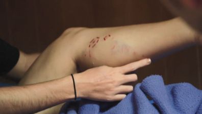 Melissa reveals her wounds after being bitten by an American crocodile.