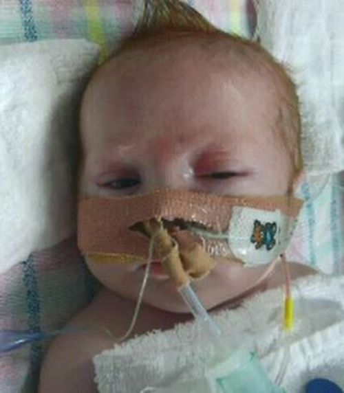 Brodie suffered from congenital lobar emphysema. (Supplied)