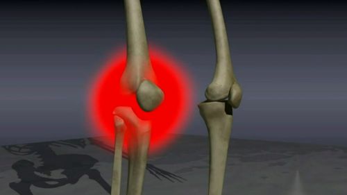 More than two million people in Australia have osteoarthritis. 