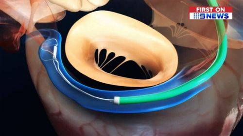 It is designed to reduce the amount of leakage through the mitral valve without the need for surgery. (9NEWS)