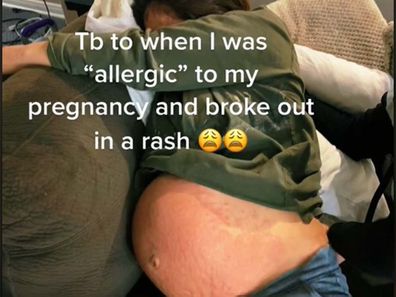 Woman lying on her side with her pregnant belly with a rash on it exposed.