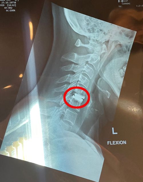 Tamara Watkins was suffering from extremely painful headaches, back pain and nausea before an MRI showed a bone spur was growing into her spine. This x-ray shows her spine after surgery.