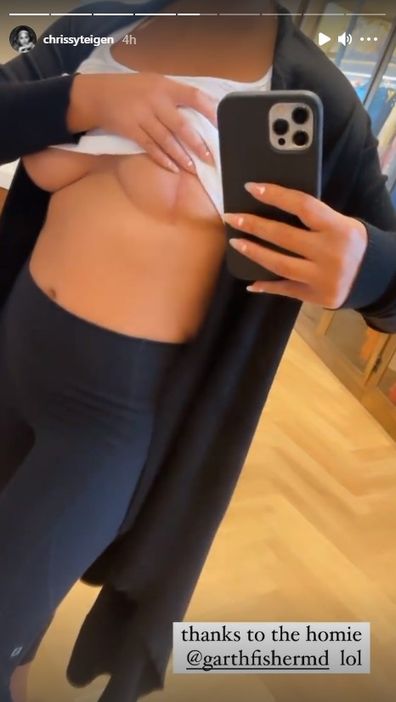 Chrissy Teigen shares new photo of surgery scars.