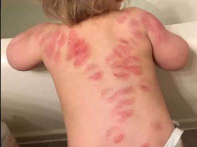 Child bitten 25 times at day care in US