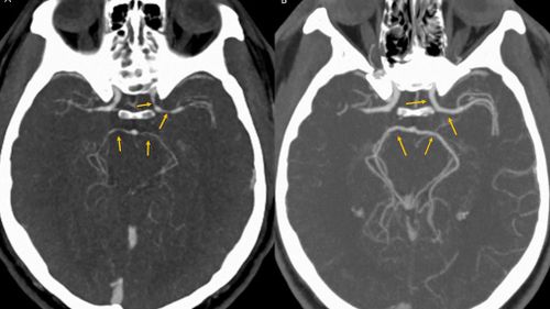 The creation comes after a US man suffered a rare case of 'thunderclap headaches' where arteries in his brain constricted as a result of eating a Carolina Reaper. Picture: BMJ. 