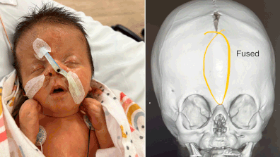 Baby Daisy has Apert Syndrome which causes skull abnormalities