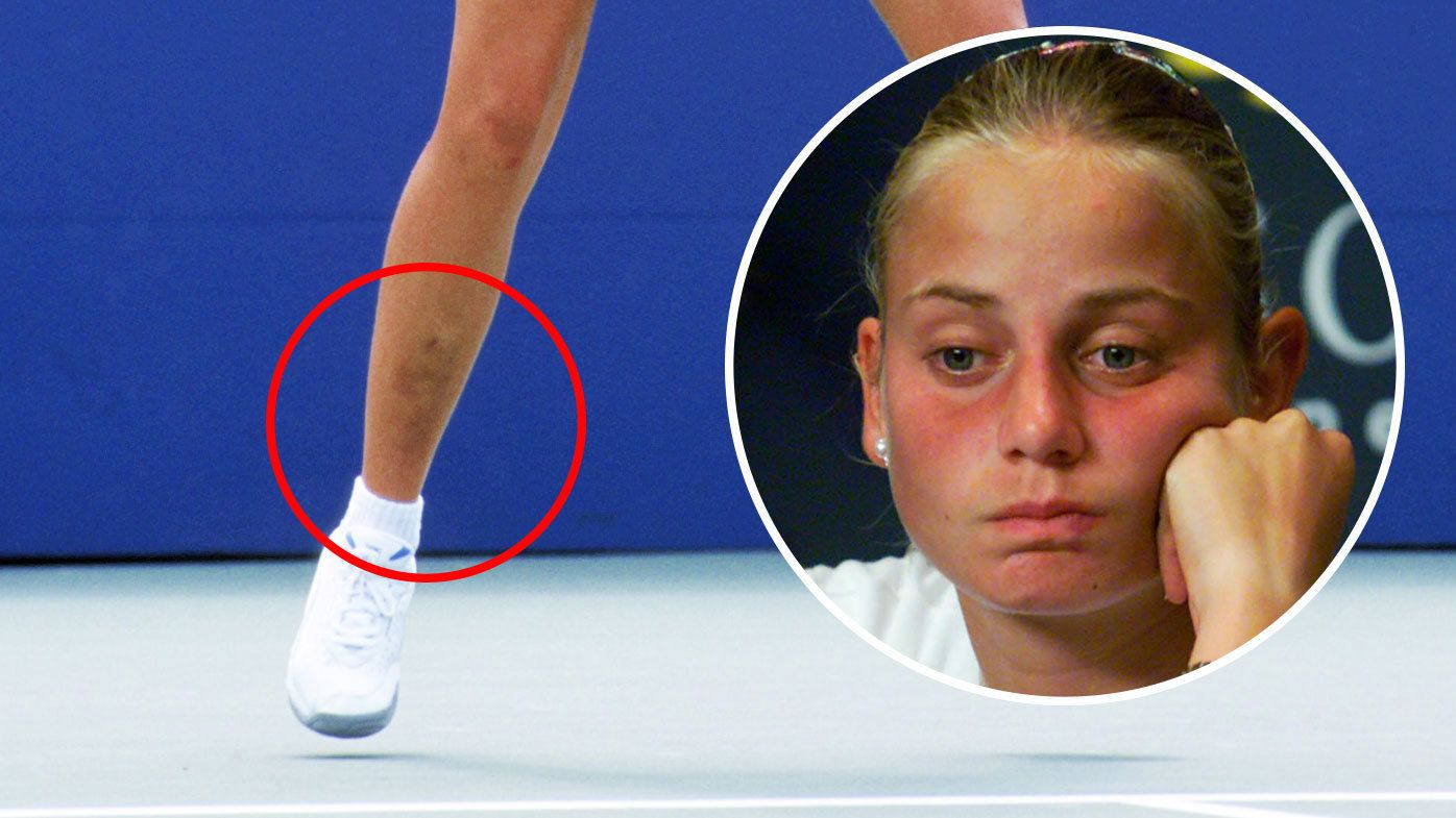 Jelena Dokic shared an image of bruising on her shins. INSET: Dokic pictured at the 2000 US Open