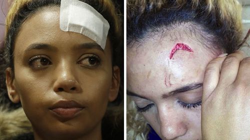 Gabriella Engels alleges the Zimbabwean First Lady inflicted this wound in Johannesburg while she was visiting Mugabe's sons. (AAP)