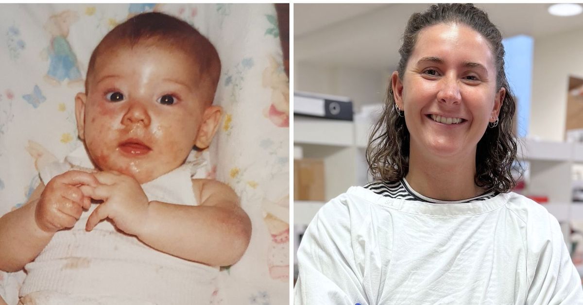 Why this lifelong allergy sufferer is devoted to finding a cure