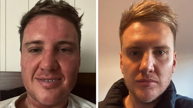 MAFS' Liam Cooper on getting fat injected in his face. 