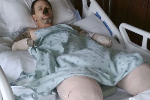 Greg Manteufel, 48, from Wisconsin has undergone at least 10 surgeries during which medics amputated parts of each of his limbs because circulation to his extremities shut down due to the infection from dog saliva.