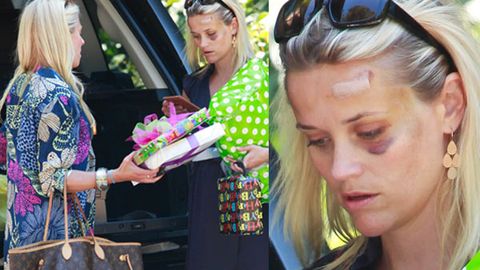 Reese Witherspoon's reveals black eye after being hit by a car
