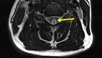 The inverted &quot;V&quot; sign as shown in this medical scan is evidence of spinal damage through nitrous oxide use.