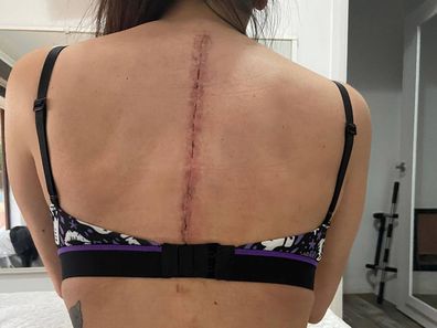 The scar on Christina Vithoulkas' back from surgery after the accident that broke her back.