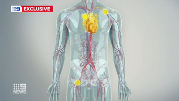 Thousands more Australians now eligible for heart valve disease keyhole surgery
