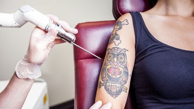 Laser Tattoo Removal