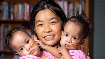 Bhutanese conjoined twins Nima and Dawa are spending time with new friends.