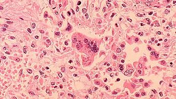 Microscopic image of measles infection (Getty)