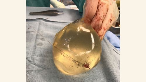 Doctors believe the woman's life was saved because of her implants, which affected the trajectory of the bullet.