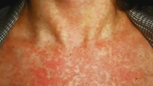 Measles causes a red, blotchy rash to stretch from the head and neck to the rest of the body.