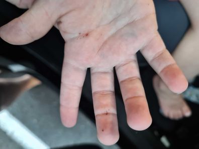 Casey counted more than 20 splinters across his hand. 
