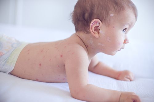 Babies and young children are particularly prone to serious complications from measles. (Getty Images)