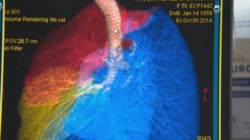 New trial using polymer foam to heal damaged lungs.