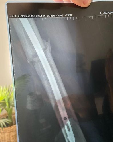 An x-ray of the injury to Jordon Hunt's leg.