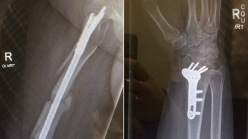X-rays of Ms McDonald's right femur (left) and wrist (right). Pictures: Jade McDonald