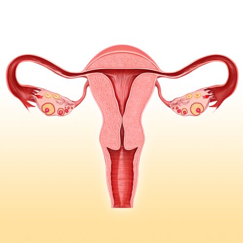 Polycystic ovary syndrome is caused by a hormone imbalance in the brain and ovaries which causes the ovaries to make extra testosterone.