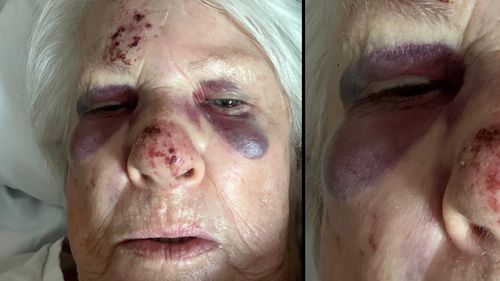 A﻿n eldery woman has been left brusied and with a brain bleed after she was hit by a child on an e-bike.