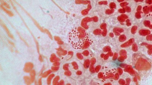 A strain of 'superbug' gonorrhoea has been reported in several countries including Australia, the United Kingdom, France, Japan and Spain.