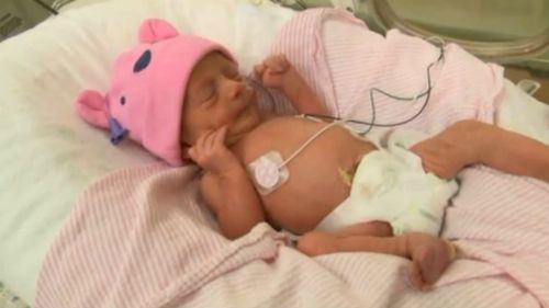 US woman who gave birth to rare twins was unaware she was pregnant