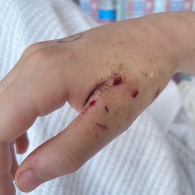 Clemency had 12 puncture wounds in her hand after getting in the middle of a cat fight 