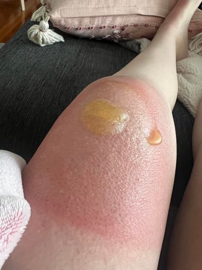 Pregnant woman Kara Lorraine shares photos of horrific sunburn after just 30 minutes in hot sun.