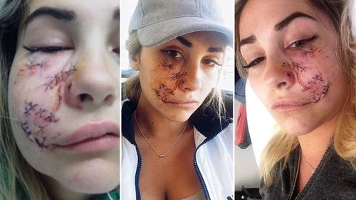 She suffered several deep lacerations to her face which also caused nerve damage.