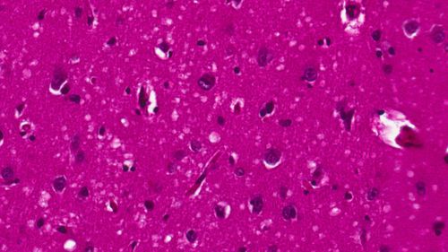 The impact of vCJD - the human variant of mad cow disease - on brain cells.