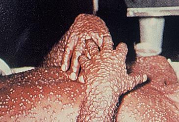When did the World Health Organization declare smallpox had been eradicated?