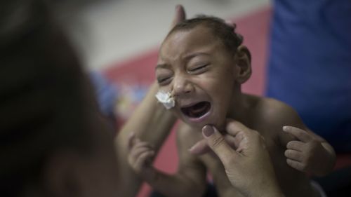 When a pregnant woman is infected with Zika, she faces a higher risk of bearing an infant with an unusually small head. (AAP)