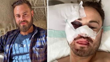Cameron Johnson suffered multiple fractures to his eye socket as a result of a scooter accident in Kuta, Bali.