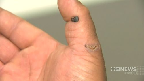 Mr Tuiloma was bitten on the hand and underwent blood tests. (9NEWS)