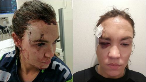 Ms Hardiman required nine stitches to her forehead. (9NEWS)