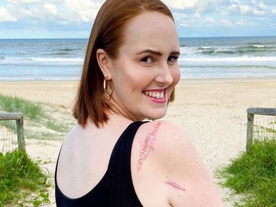 Skin cancer survivor Courtney Mangan shows the scars on her arm.