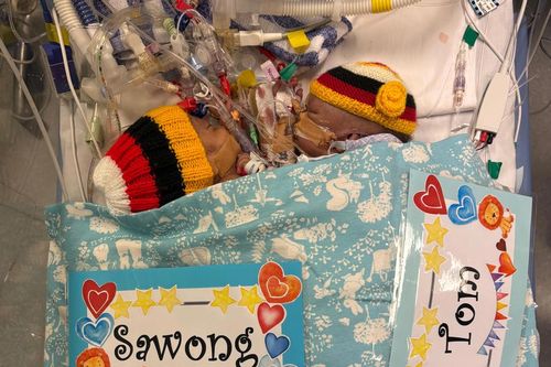 O﻿ne of the conjoined twins who were flown from Papua New Guinea to Australia in a desperate attempt to save them has died following an emergency surgery. 