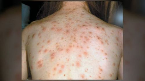 Symptoms of measles include a general fever, sore eyes and a cough that is followed a few days later by a blotchy rash that spreads from the head and neck to the rest of your body.