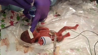 Girl believed to be tiniest newborn weighed as much as apple