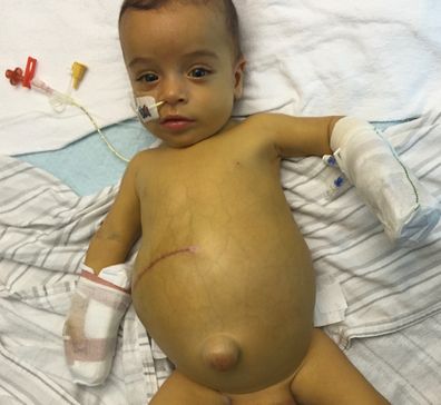 Baby Hunter was diagosed with a rare liver disease and required an urgent liver transplant