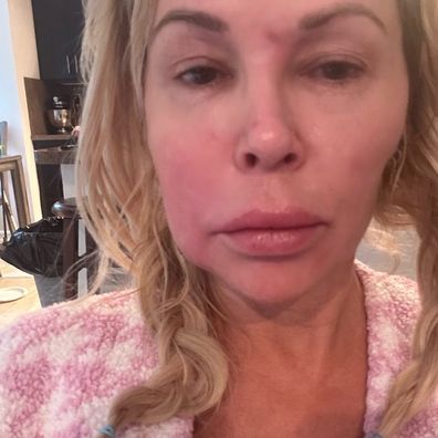 Brandi Glanville Face Disfigurement